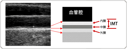 頸動脈エコー検査